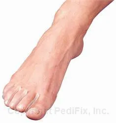 PEDIFIX GEL TOE SEPARATORS - PFP31